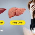 good diet for fatty liver