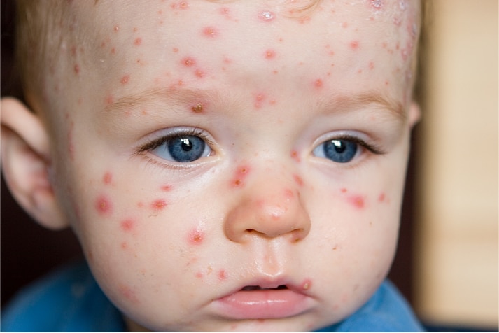 Chicken Pox- Common Childhood Communicable Diseases