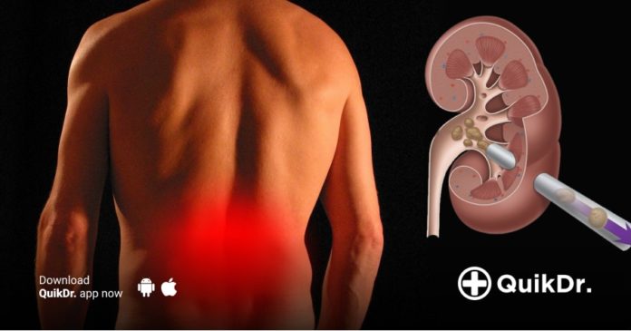 kidney-stone-symptoms-prevention-tips