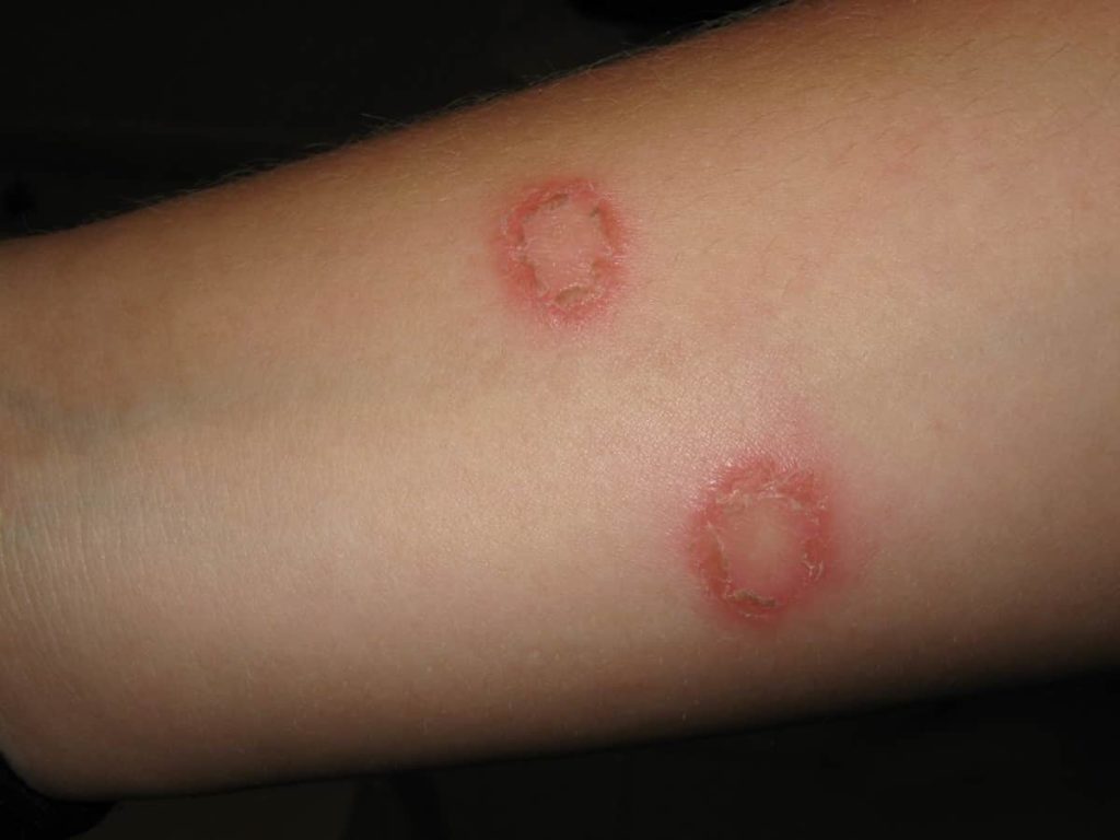 Fungal Infections of the Skin-Ringworm